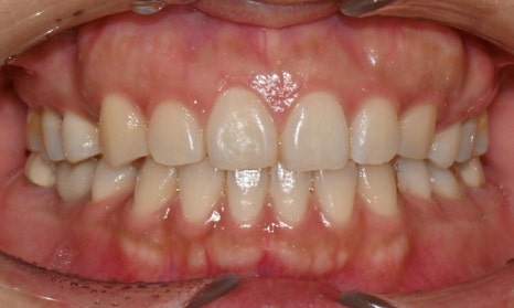 앞니 벌어짐 부분교정 (재교정) 관련 이미지 8