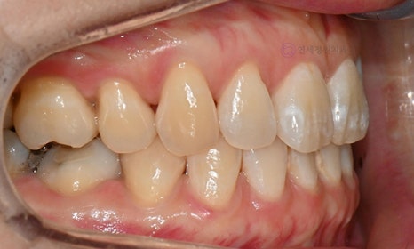 앞니 치아 하얀 점, 충치인가요? (화이트 스팟, 반점치) 아이콘 레진 치료의 순서 관련 이미지 4