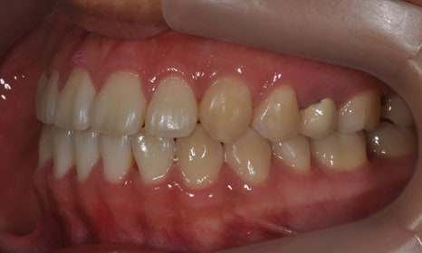 치아 중심선 비대칭 및 개방교합 교정, 대치동 연세정원치과 관련 이미지 8