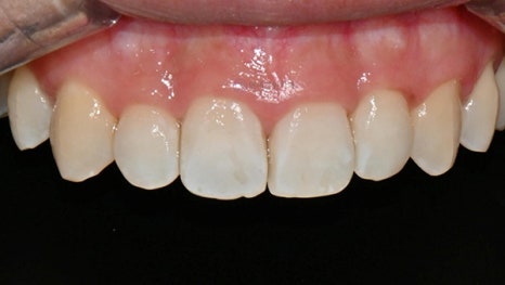 교정치료 후 생긴 치아 하얀 점, 반점치도 아이콘 치료로! @ 대치동 교정치과 연세정원치과의원 관련 이미지 7