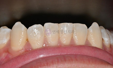 치아 미백 후 반점치의 아이콘 레진 치료 @ 대치동 연세정원치과 관련 이미지 7