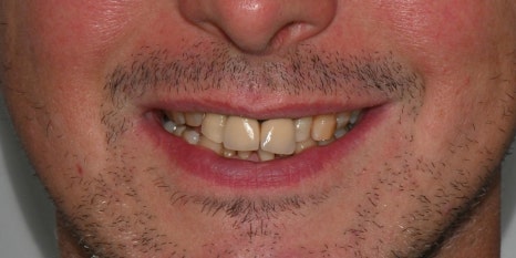 과개교합과 손상된 앞니, 심미와 기능을 함께 회복한 앞니 심미보철 케이스 관련 이미지 13