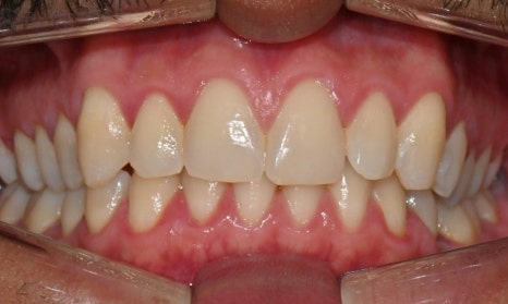 Invisalign Transfers for Immigration, Studying Abroad, Relocation, and More — International Students and Military Personnel image 5