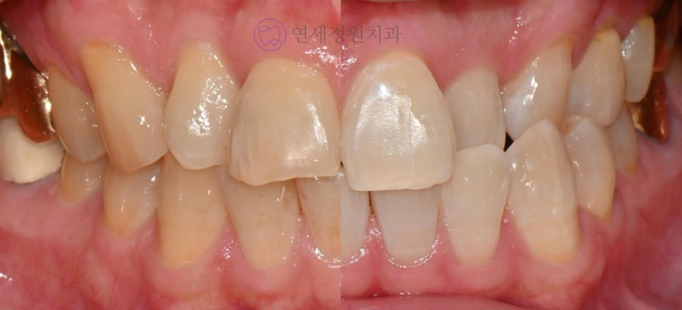 Precautions for Teeth Whitening Treatment @ Yonsei JW Dental Clinic 관련 이미지 2