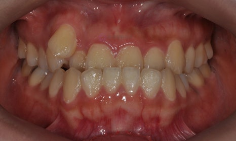 비수술 주걱턱 교정, 대치동 교정치과 연세정원치과 관련 이미지 12