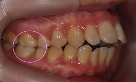 앞니가 안 물려요! 개방교합(openbite) 치아교정 전후 및 후기 관련 이미지 2