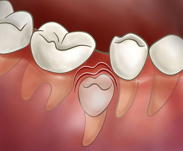 소아교정의 중요성 : 적절한 시기에 유치를 빼주는 것이 중요한 이유 @ 대치동 교정치과 연세정원치과 관련 이미지 3