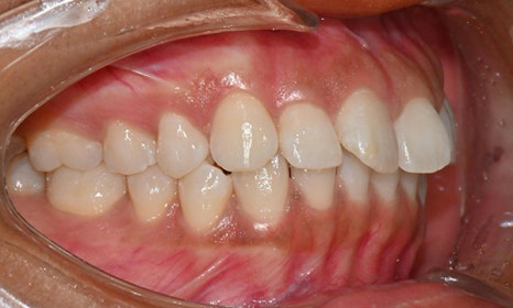 개포동 앞니 사이 공간 및 덧니 교정을 원한다면 관련 이미지 3