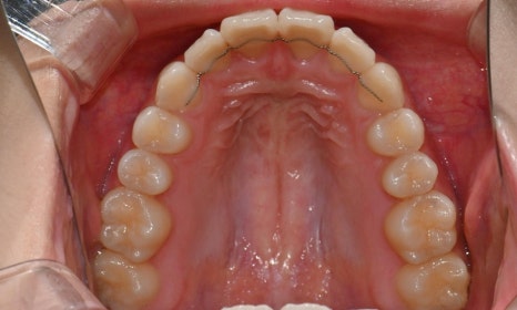 고등학생 인비절라인 교정｜앞니 치아배열 &middot; 과개교합 관련 이미지 20