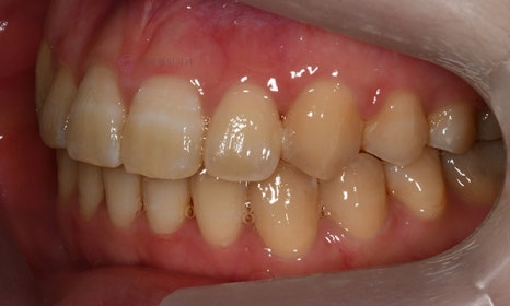 치아 중심선이 안 맞아요! 치아 비대칭 교정으로 가능할까요? @ 대치동 교정치과 연세정원치과 관련 이미지 28