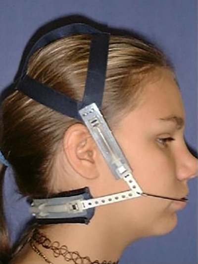 아이들이 더 좋아하는 인비절라인 퍼스트 @ 대치동 교정치과 연세정원치과 관련 이미지 9