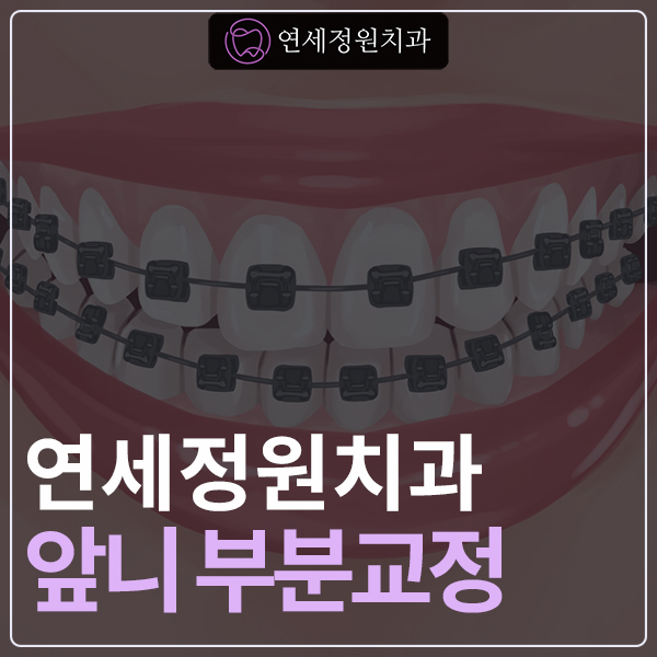 앞니 벌어짐 부분교정 (재교정) 관련 이미지 1