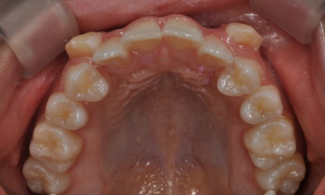 어금니가 겹쳐서 났어요! 이소맹출 소구치 치아교정, 대치동 교정치과 관련 이미지 3