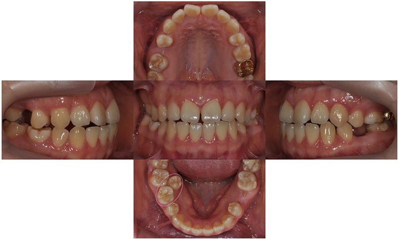 어금니가 겹쳐서 났어요! 이소맹출 소구치 치아교정, 대치동 교정치과 관련 이미지 4