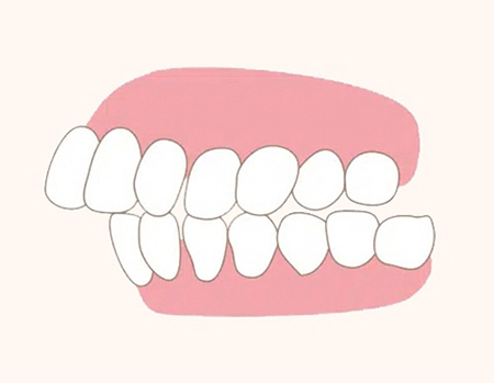 어린이 치아교정 해야 될까요? 대치동 교정치과 관련 이미지 3