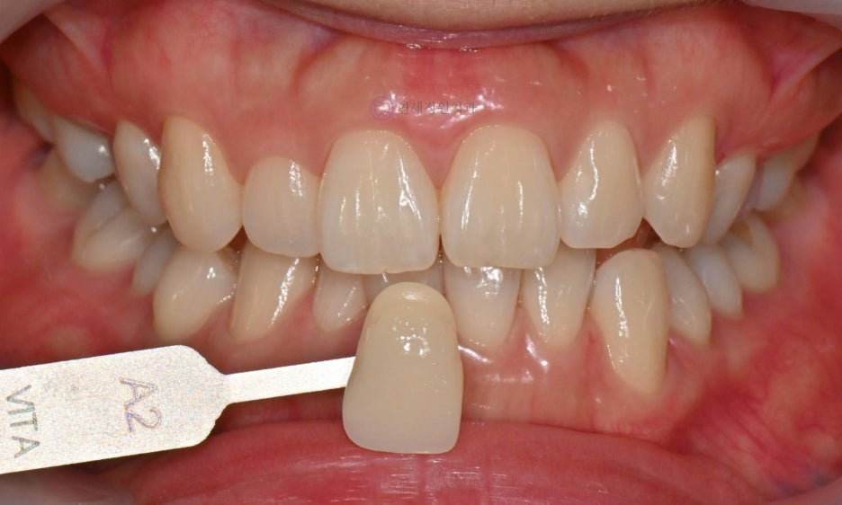 One Day Teeth Whitening Process @ Yonsei JW Dental Clinic 관련 이미지 8