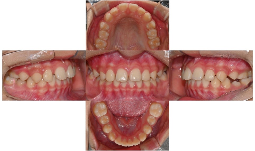 어린이 무턱 액티베이터 성장교정 후 인비절라인 퍼스트 관련 이미지 8