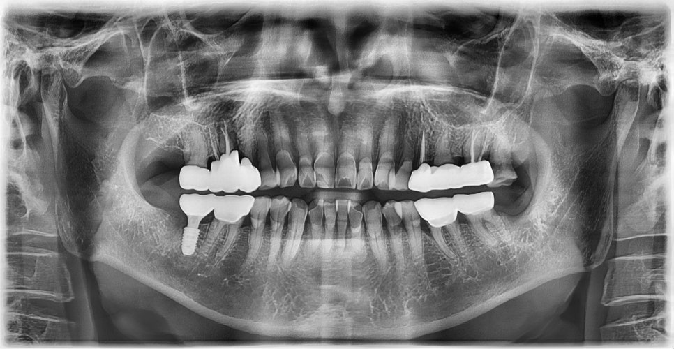 임플란트와 고혈압, 당뇨, 골다공증 등의 전신질환 관련 이미지 4