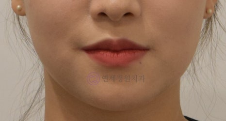 치아 중심선이 안 맞아요! 치아 비대칭 교정으로 가능할까요? @ 대치동 교정치과 연세정원치과 관련 이미지 9