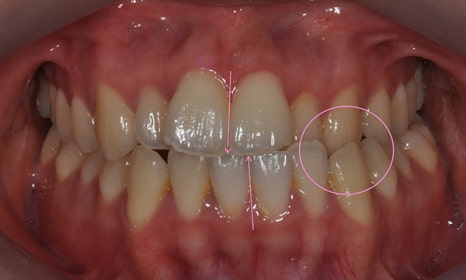 비대칭 및 돌출입 치아교정, 대치동 교정치과 연세정원치과 관련 이미지 16