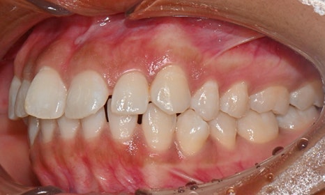 인비절라인 앞니 사이 공간 및 덧니 교정 관련 이미지 4