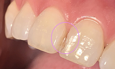 Dental Bonding for Gaps Between Front Teeth & Black Triangles | Gangnam, Seoul 관련 이미지 9