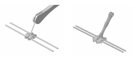 악궁확장장치(RPE, MARPE, MSE) 돌리는 방법 관련 이미지 16