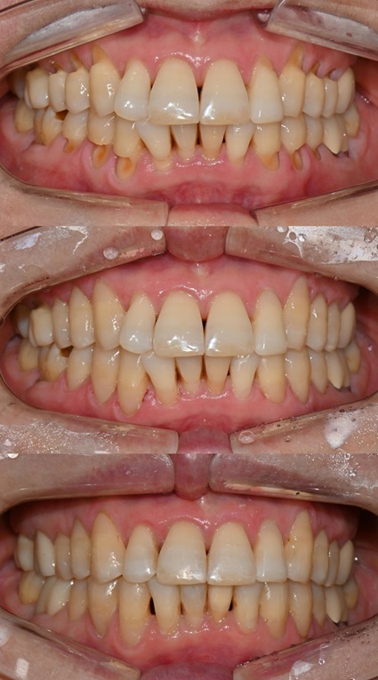 대치동 치경부 레진 & 중년교정 & 치아미백으로 자연스러운 미소를! 관련 이미지 19