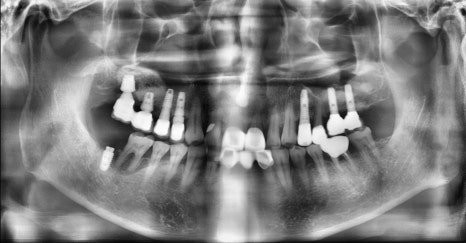 임플란트 1차 수술 vs 2차 수술 관련 이미지 5