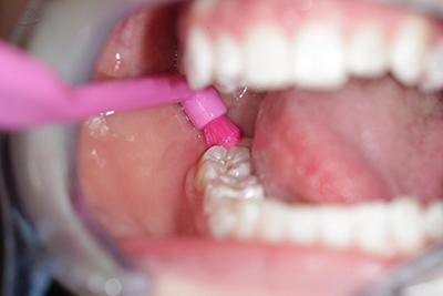 치아교정시 양치법 및 구강위생관리 방법 관련 이미지 7