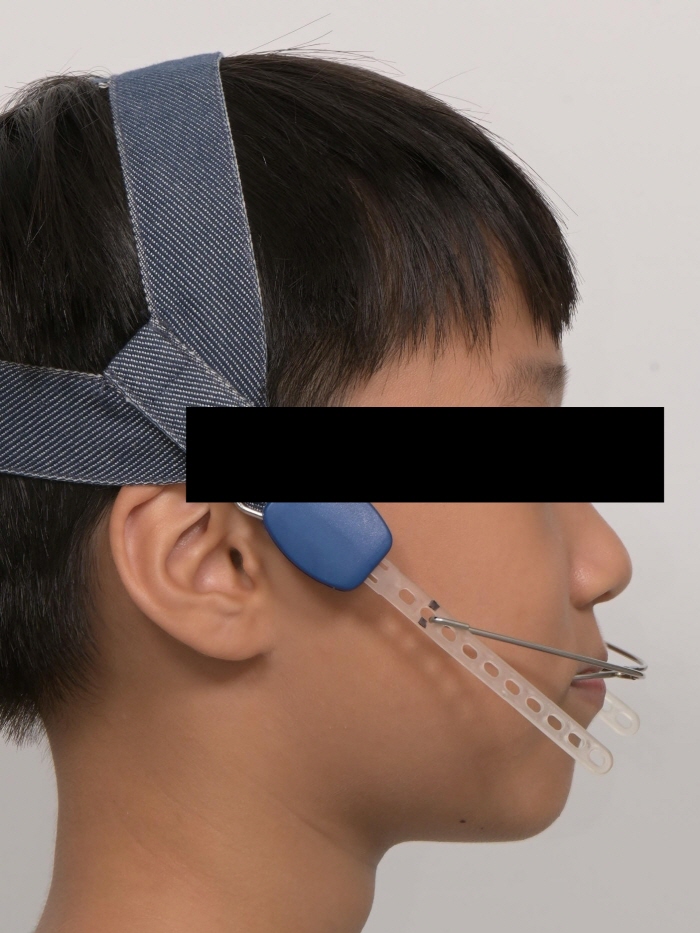 어린이 무턱 액티베이터 성장교정 후 인비절라인 퍼스트 관련 이미지 7