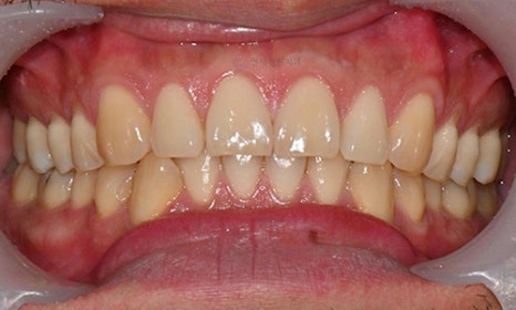 Teeth Whitening Case : A couple from the Netherlands 관련 이미지 4