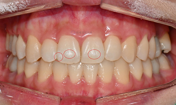 교정치료 후 생긴 치아 하얀 점, 반점치도 아이콘 치료로! @ 대치동 교정치과 연세정원치과의원 관련 이미지 3