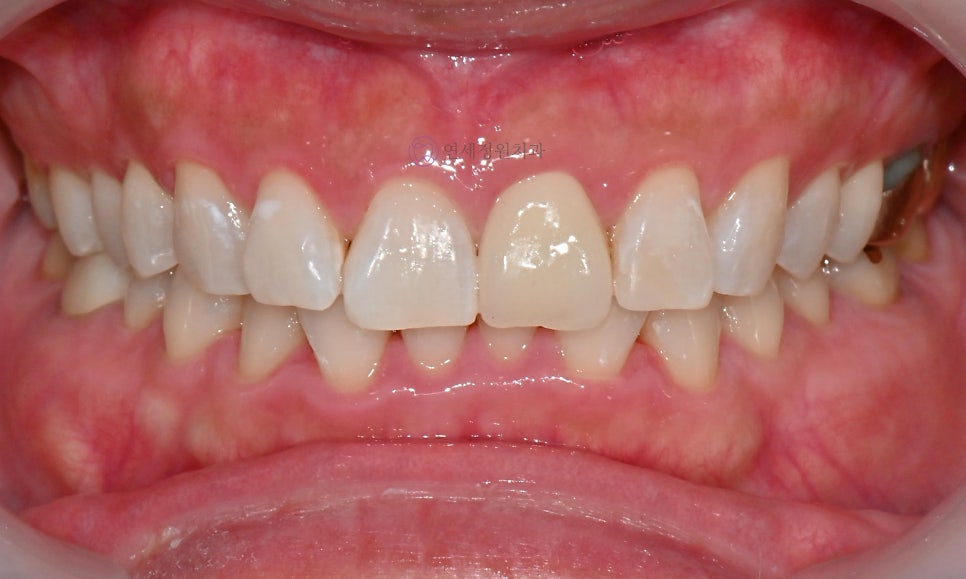 원데이 치아미백 - 앞니 크라운 사례 관련 이미지 6