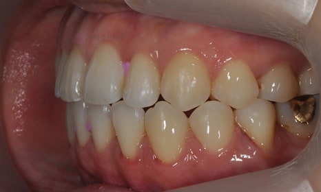 치아 중심선이 안 맞아요! 치아 비대칭 교정으로 가능할까요? @ 대치동 교정치과 연세정원치과 관련 이미지 20