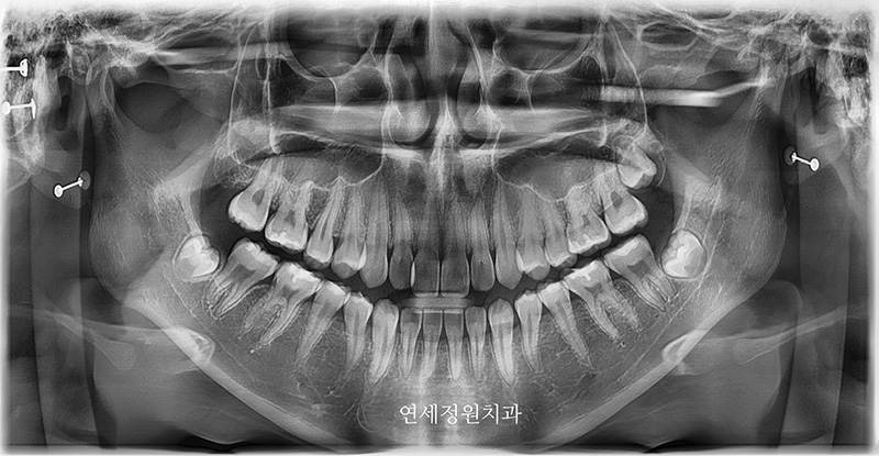 유학생 치아교정, 인비절라인 연세정원치과 관련 이미지 10