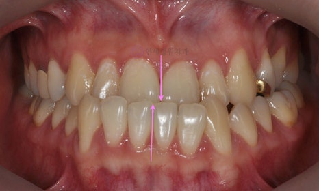 비대칭 및 돌출입 치아교정, 대치동 교정치과 연세정원치과 관련 이미지 4