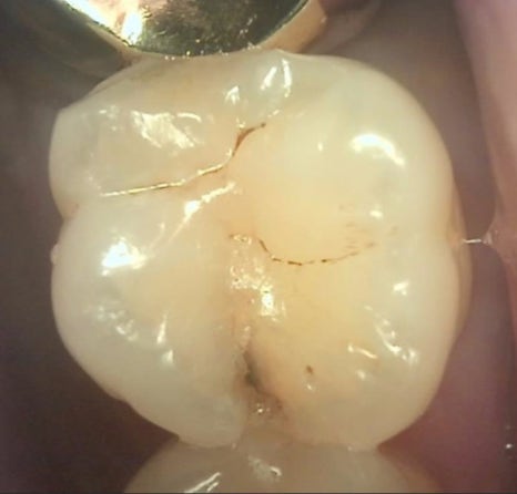 충치, 금이 간 치아의 정확한 진단, 큐레이펜 C(Qraypen C)를 활용한 큐레이 검사 @ 대치동치과 연세정원치과의원 관련 이미지 6