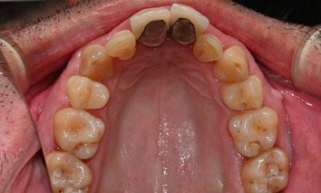 과개교합과 손상된 앞니, 심미와 기능을 함께 회복한 앞니 심미보철 케이스 관련 이미지 6