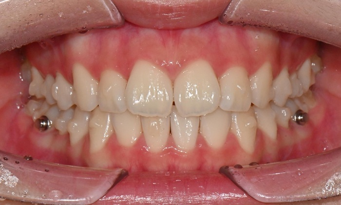 고등학생 인비절라인 교정｜앞니 치아배열 &middot; 과개교합 관련 이미지 12