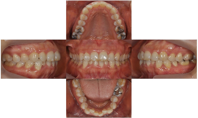 중년의 치아교정 시 고려할 사항, 대치동 연세정원치과 관련 이미지 2