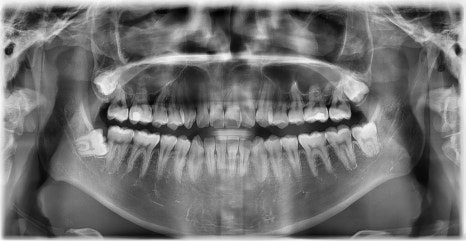 치아 중심선 비대칭과 아랫입술 돌출 개선 관련 이미지 23