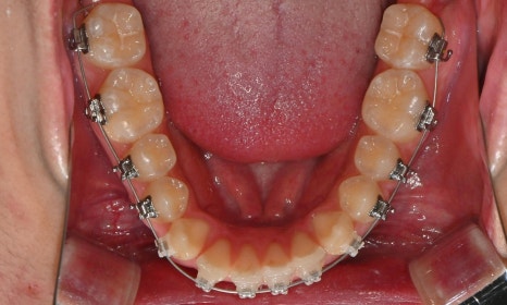 치아 중심선 비대칭과 아랫입술 돌출 개선 관련 이미지 12