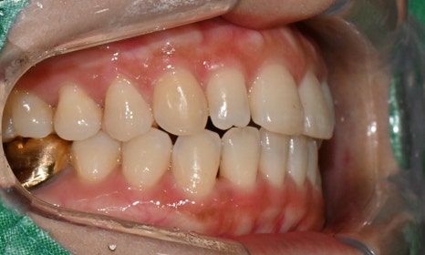 왜소치 치료 - 라미네이트 vs 레진비니어 vs 치아교정 관련 이미지 12