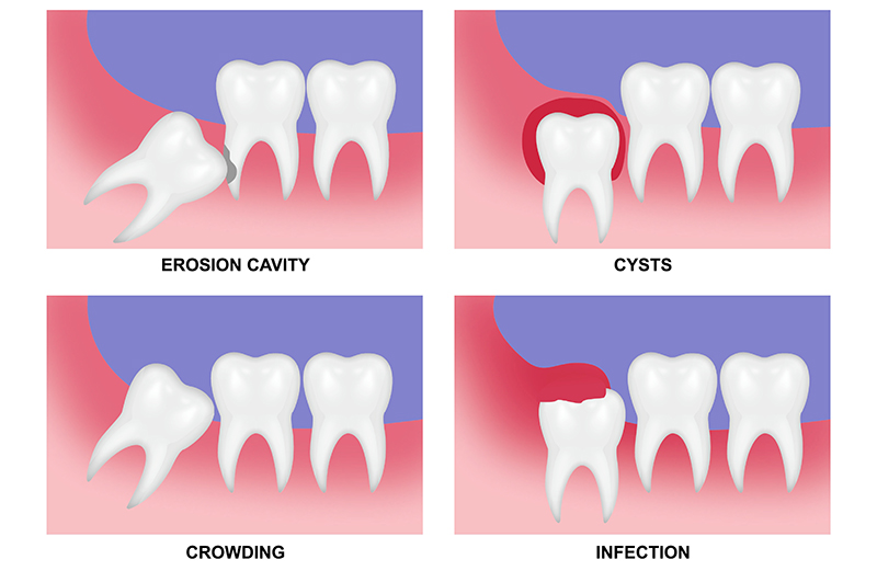 Do You Really Need to Remove Your Wisdom Teeth? 관련 이미지 3