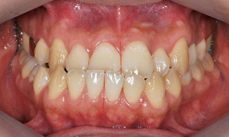 주걱턱 치아 교정만으로 치료 가능할까요? @ 대치동 교정치과 연세정원치과 관련 이미지 7