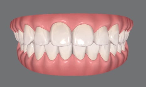 Invisalign Transfers for Immigration, Studying Abroad, Relocation, and More — International Students and Military Personnel image 4