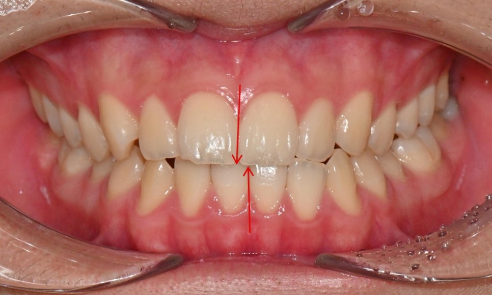 치아 중심선 비대칭과 아랫입술 돌출 개선 관련 이미지 3