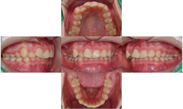 성장기 무턱교정 인비절라인 MA(mandibular advancment) 관련 이미지 4