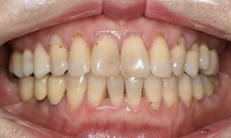 레진 비니어 등의 레진 치료를 이용한 앞니 형태 개선 (왜소치, diastema, black triangle) @ 대치동 연세정원치과 관련 이미지 9